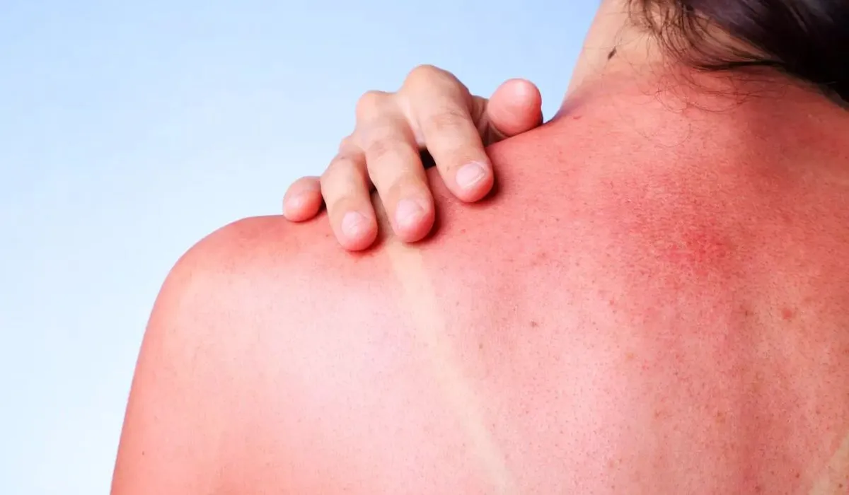 Cách phục hồi da bị cháy nắng hiệu quả tại nhà
