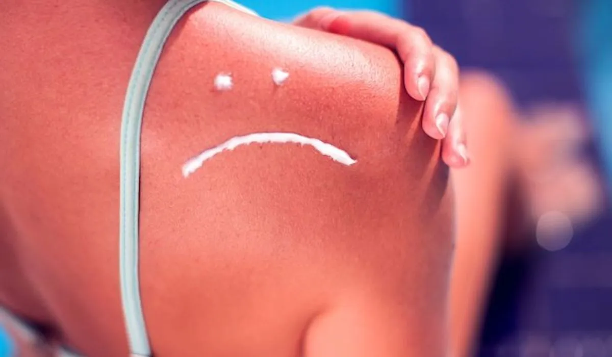Cách phục hồi da bị cháy nắng hiệu quả tại nhà