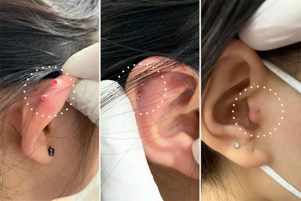 Xỏ Tragus có đau không? Xỏ Tragus nên chọn khuyên gì đẹp?