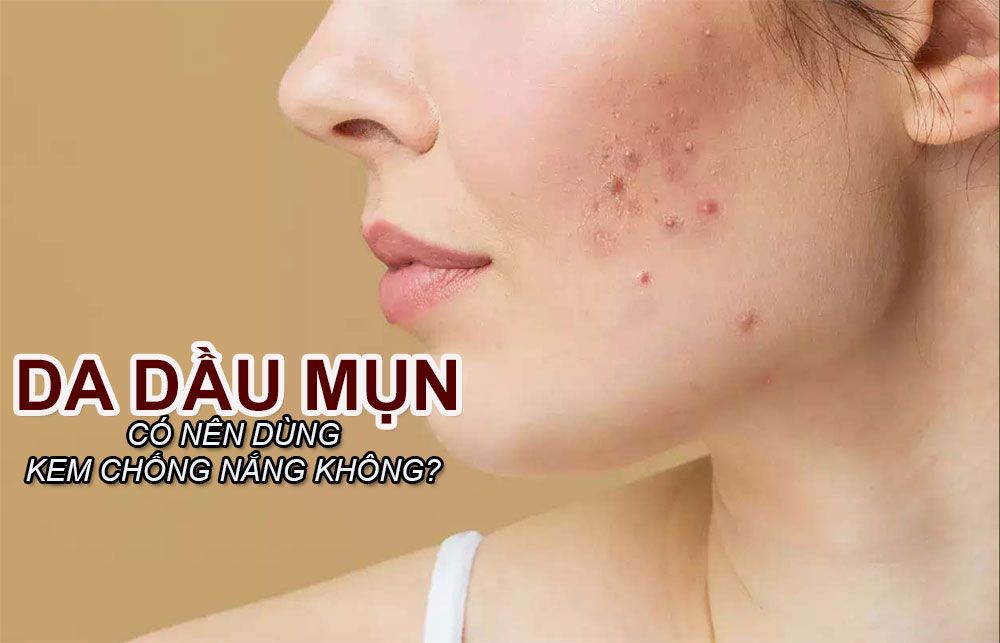 Top 10 kem chống nắng không gây mụn, thân thiện với làn da cho da