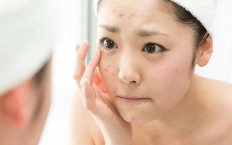 Da dầu mụn? Đừng lo, đã có serum cho tuổi dậy thì giúp bạn tự tin tỏa sáng