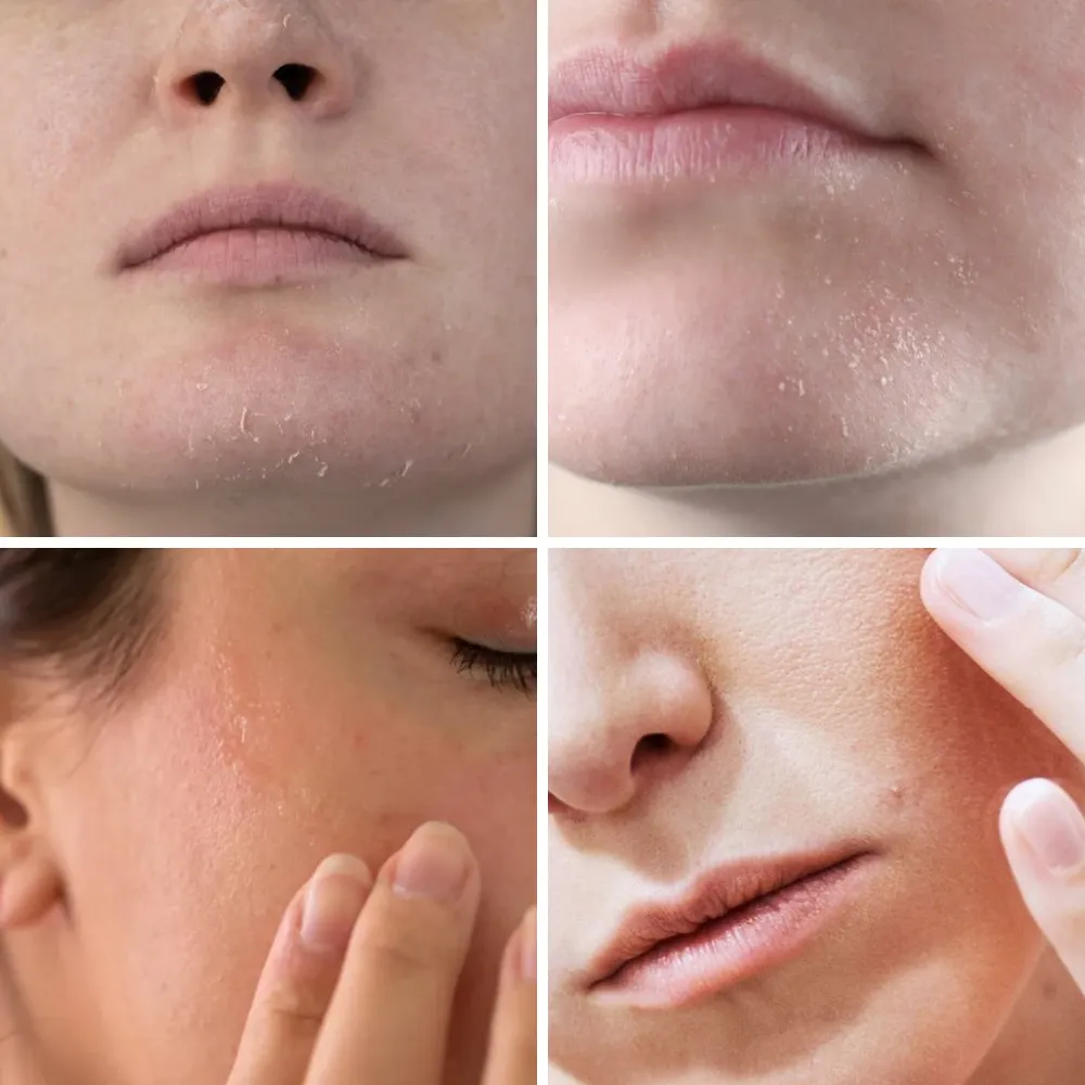 Bí quyết phục hồi da mặt bị bong tróc giúp da mịn màng mỗi ngày - 1