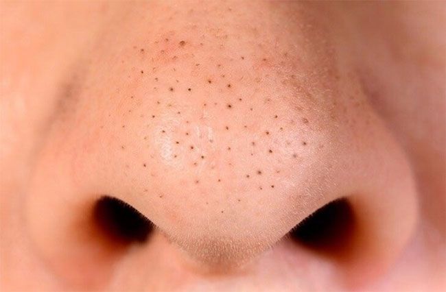 Top 7 kem hỗ trợ làm sạch mụn đầu đen trên mũi hiệu quả cho da sáng mịn