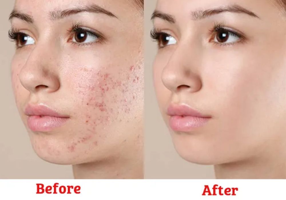 Retinol giúp điều trị mụn và chống lão hóa, làm mịn da