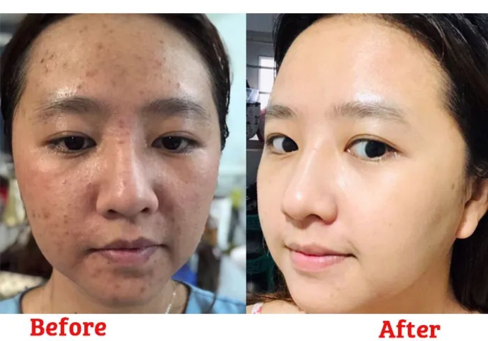 Tre có tác dụng hiệu quả trong việc điều trị mụn, nám, tàn nhang