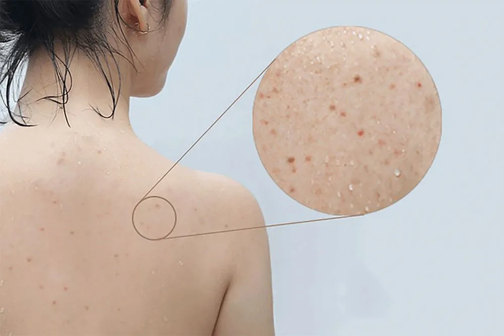 Top 10 loại xà bông tắm hỗ trợ làm sạch mụn lưng chất lượng tốt nên mua