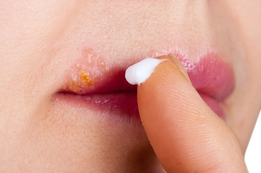 Tìm hiểu về dị ứng son môi và cách xử lý hiệu quả