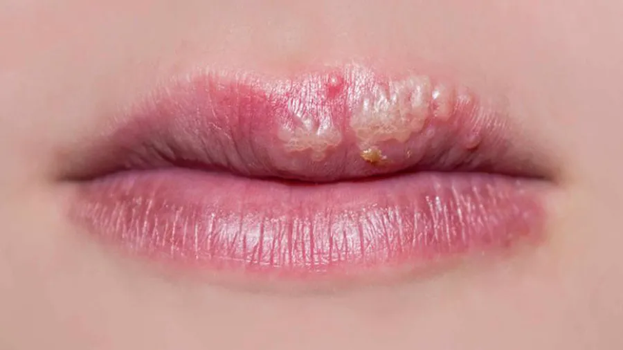 Tìm hiểu về dị ứng son môi và cách xử lý hiệu quả