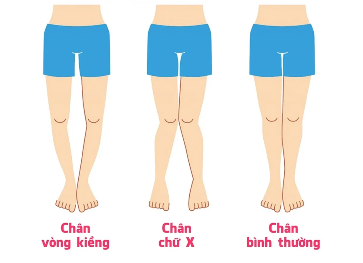 Chân cong mặc gì đẹp?10+ cách phối đồ 