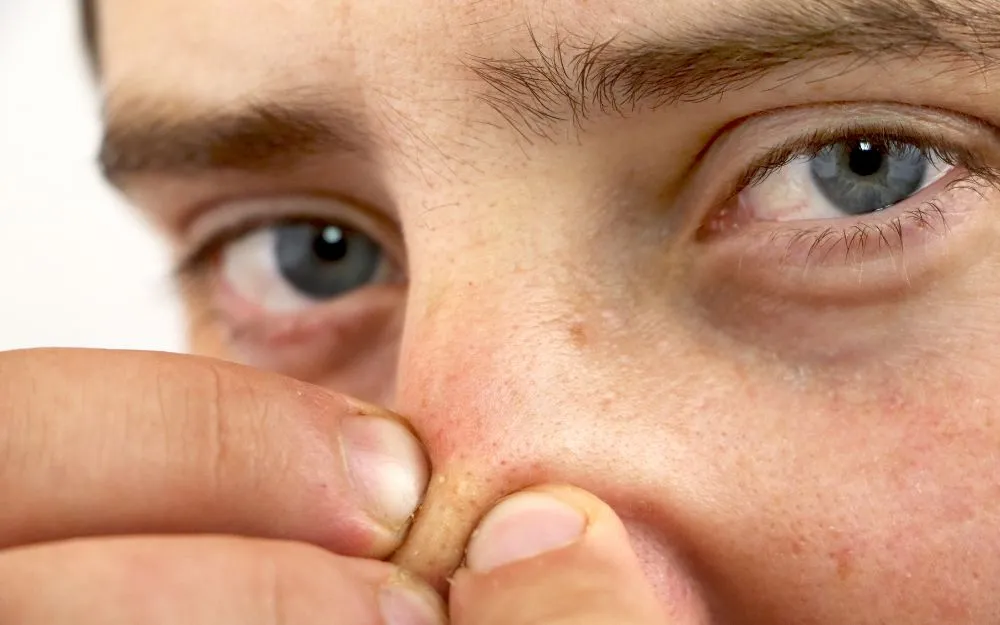 Mẹo Hỗ Trợ Làm Sạch Mụn Đầu Đen Ở Mũi Bằng Vaseline Hiệu Quả - 1