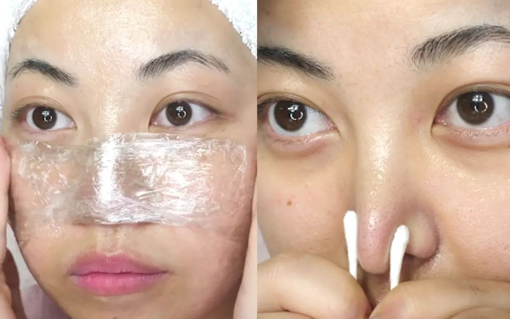 Mẹo Hỗ Trợ Làm Sạch Mụn Đầu Đen Ở Mũi Bằng Vaseline Hiệu Quả - 5