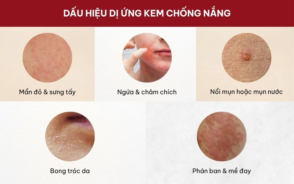 Tìm Hiểu Nguyên Nhân Dị Ứng Kem Chống Nắng & Cách Khắc Phục