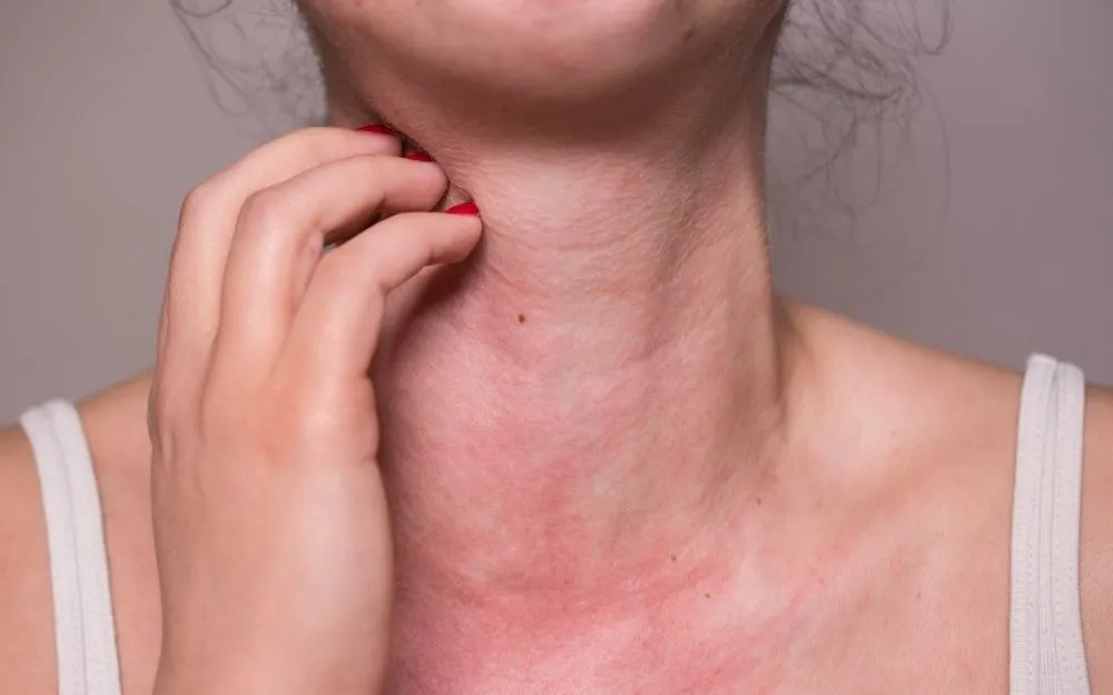 Tìm Hiểu Nguyên Nhân Dị Ứng Kem Chống Nắng & Cách Khắc Phục