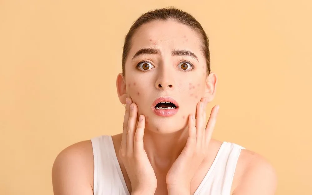 Top 15 Công Thức Làm Mặt Nạ Hỗ Trợ Làm Sạch Mụn Tại Nhà Đơn Giản