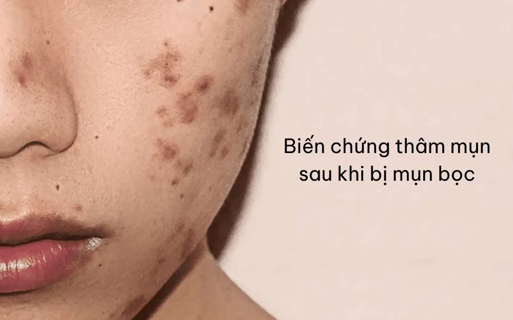 Mụn Bọc: Đặc Điểm, Nguyên Nhân Và Cách Khắc Phục Hiệu Quả