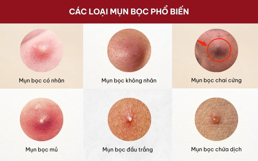Mụn Bọc: Đặc Điểm, Nguyên Nhân Và Cách Khắc Phục Hiệu Quả