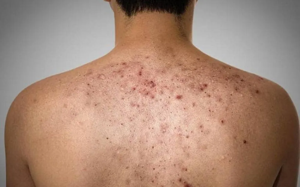 Mụn Bọc: Đặc Điểm, Nguyên Nhân Và Cách Khắc Phục Hiệu Quả