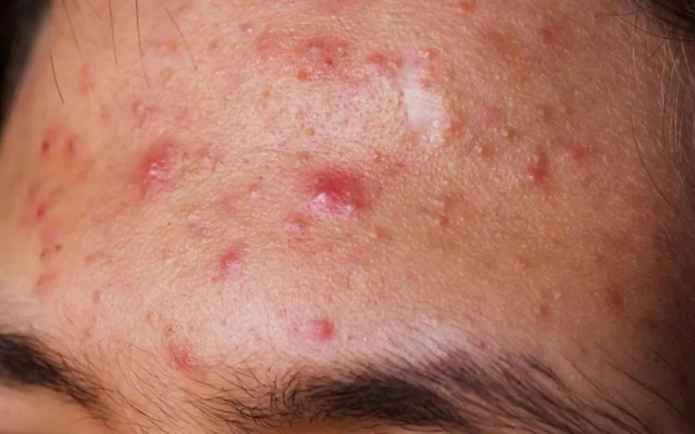 Mụn Bọc: Đặc Điểm, Nguyên Nhân Và Cách Khắc Phục Hiệu Quả