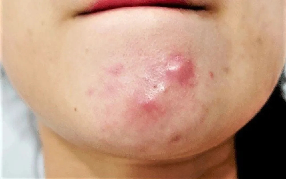 Mụn Bọc: Đặc Điểm, Nguyên Nhân Và Cách Khắc Phục Hiệu Quả