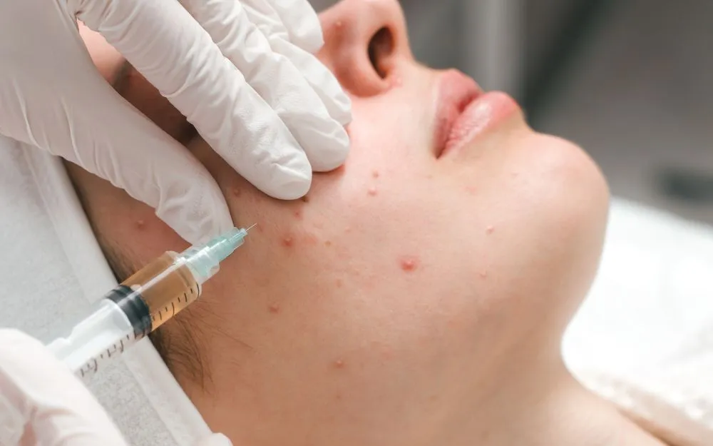 Mụn Bọc: Đặc Điểm, Nguyên Nhân Và Cách Khắc Phục Hiệu Quả