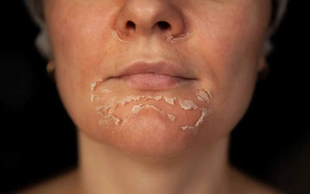 Peel Da Là Gì, Có Tốt Không? Cách Chăm Sóc Sau Khi Peel Da - 1