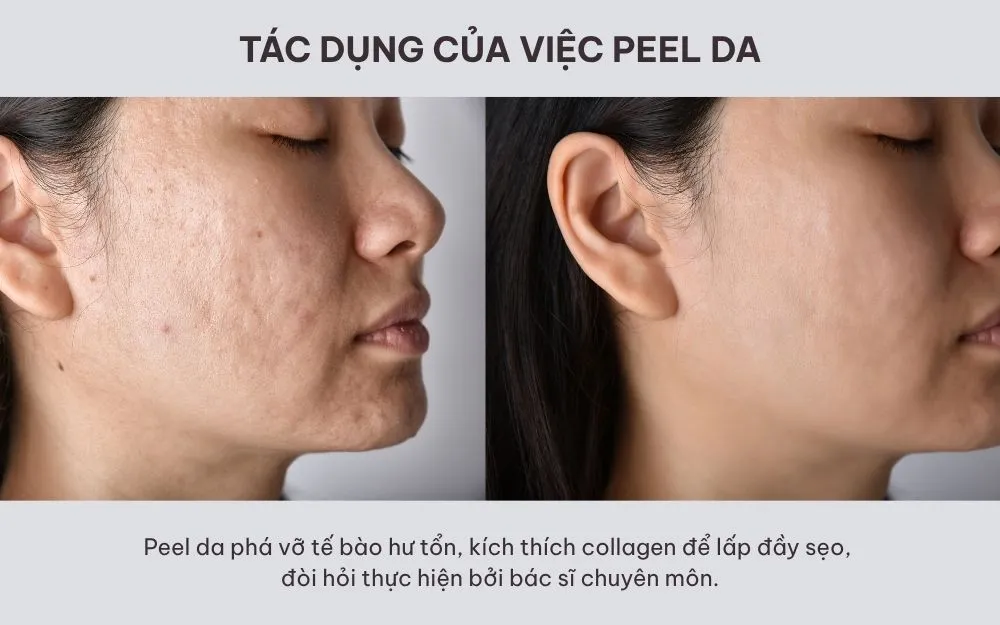 Peel Da Là Gì, Có Tốt Không? Cách Chăm Sóc Sau Khi Peel Da - 3