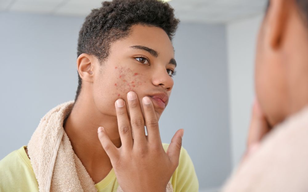 Purging Là Gì? Cần Làm Gì Trong Quá Trình Da Purging - 3