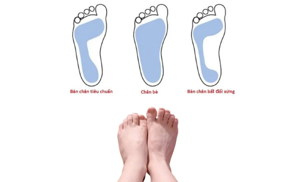 Chân bè nên đi giày gì? Các kiểu giày cho người chân bè - 1