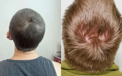 Đầu 2 Xoáy Nam Cắt Kiểu Gì Đẹp? Bí Quyết Chọn Kiểu Tóc Phù Hợp