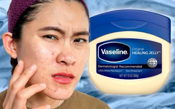 Mẹo Hỗ Trợ Làm Sạch Mụn Đầu Đen Ở Mũi Bằng Vaseline Hiệu Quả